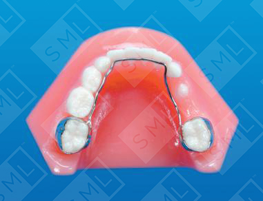 01 Lingual Arch_0