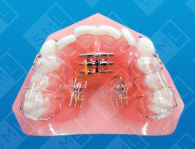hree Screw Sagittal
