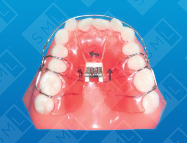3 Way Expander