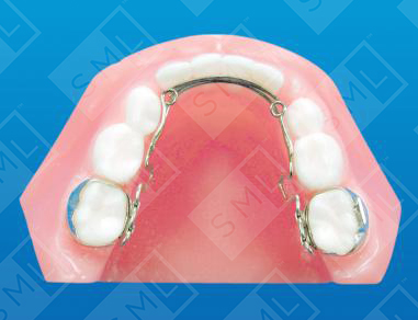 Adjustable Lingual
