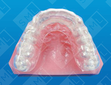 Anterior Repositioning Splint_0