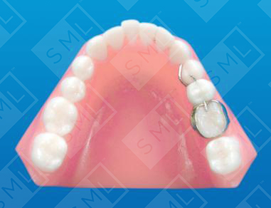 Banded Bonded Interim Splint