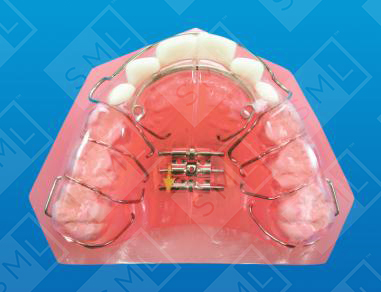 Bilateral Crossbite