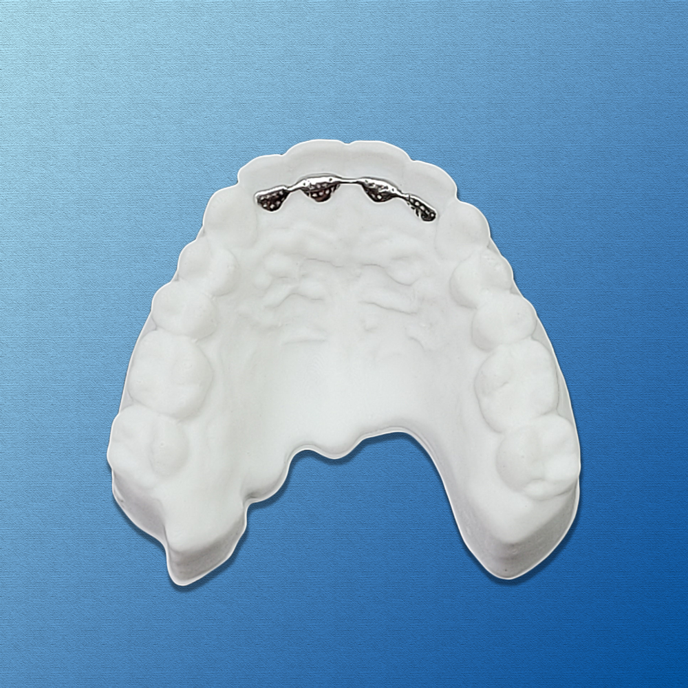Bonded Retainer_0