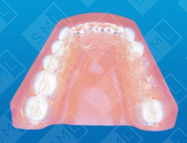 CT Scan Appliance for the partially edentulous patient
