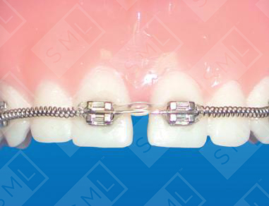 Diastema Closing_0