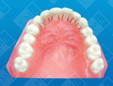 Direct Bond Fixed Retainer UL