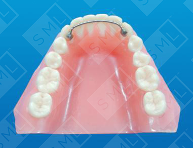 Direct Bond Fixed Retainer_0.jpg