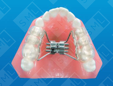 Direct Bond Suture Expansion