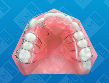 DirectBond Spring Cuspid Retraction