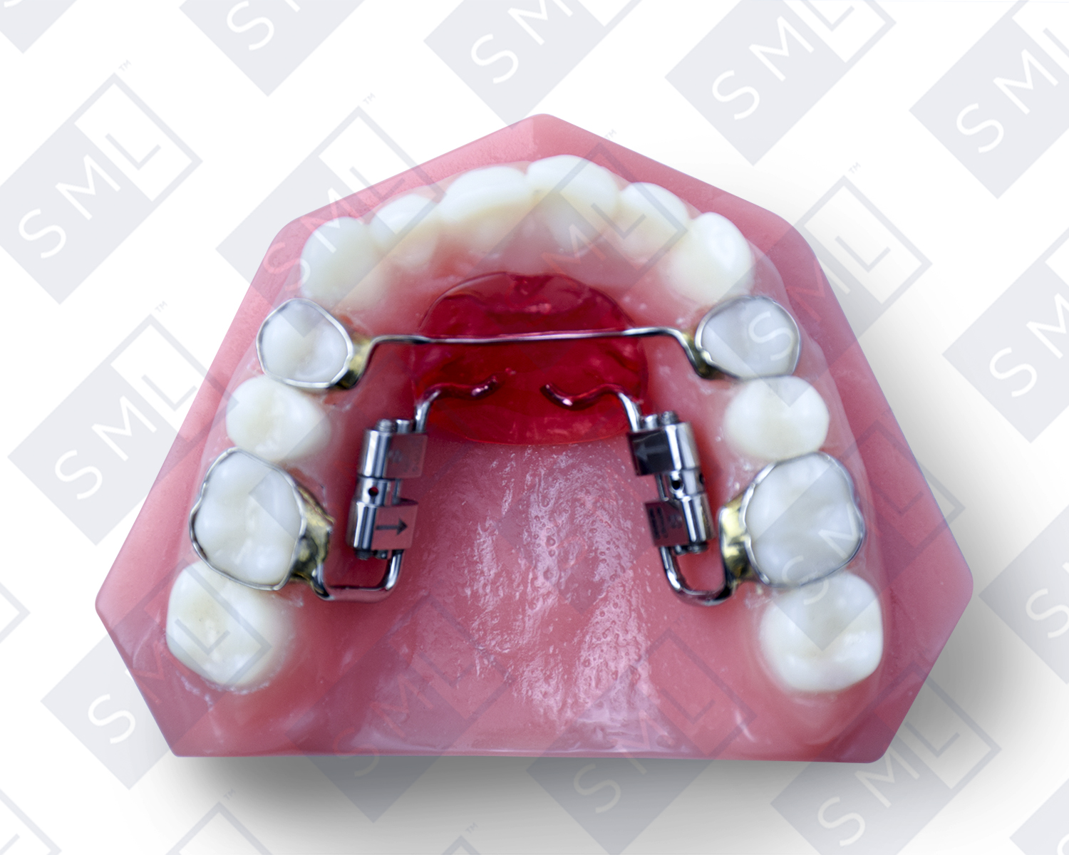 Fixed Distalizing Sagittal_watermarked