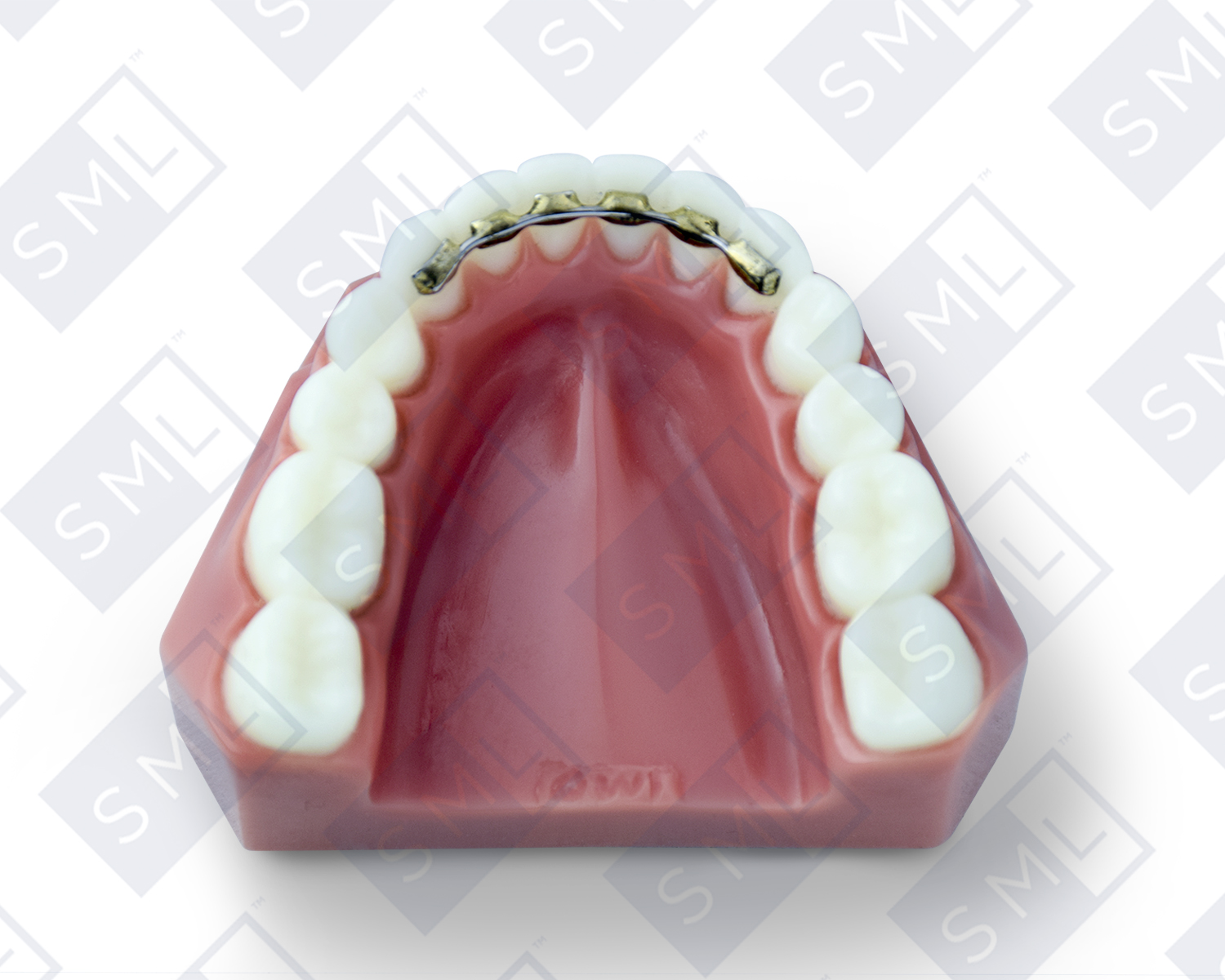 Fixed Lower Lingual Bonded Retainer_watermarked