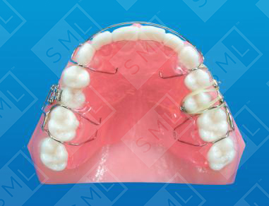 Fixed Removable Buccal Slingshot