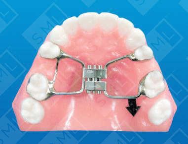 Fixed Unilateral Distalizer