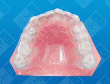 Full Palate Maxillary Bruxism Splint