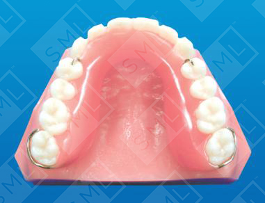 Horseshoe Temporary Partial
