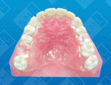 Implant Stents