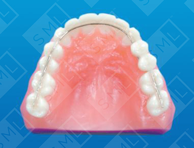 Intra Coronal Splint w Pontics_0