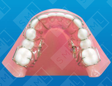 Lower Molar Disalizing Sagittal