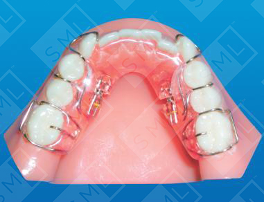 Lower Sagittal to Distalize Posterior Segments