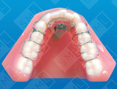 Lower Schwarz Adult Dentition C Clasps Bicuspids