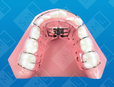 Lower Schwarz Mixed Dentition