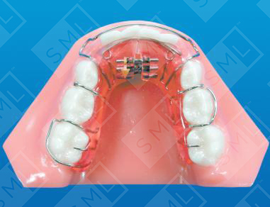 Lower Schwarz with Alternate Methods of Retention