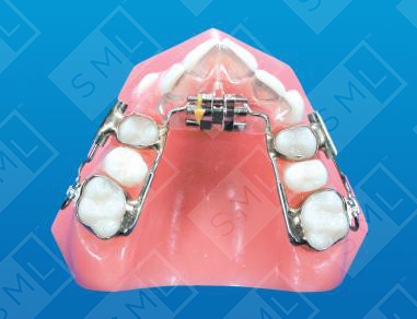 Magill Sagittal to Distalize
