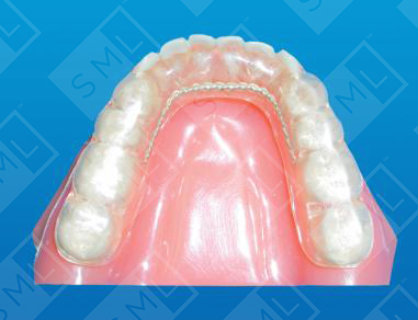 May TMJ Splint