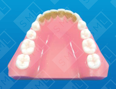 Mesh Composite Lingual Splints