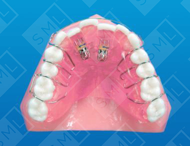 Mini Screw Appliance_0.jpg