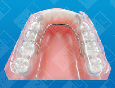 Modified Witzig Splint