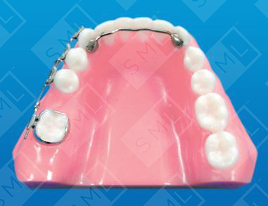 Molar Uprighting Fixed Appliance