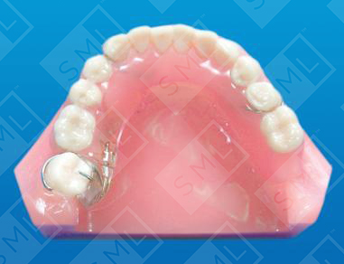 Molar Uprighting Partial