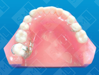 Molar Uprighting Treatment Partial_0_0