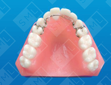 Palate-Free Temp Removable Partial Denture_1.jpg