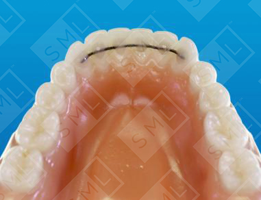 PowerProx-Bonded-Splint-1