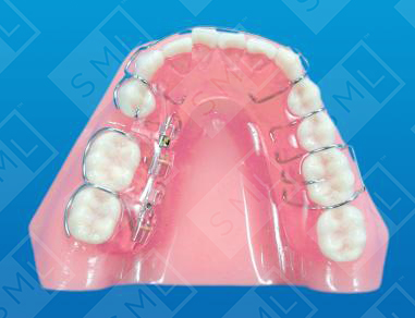 Removable Molar Distalizer_0