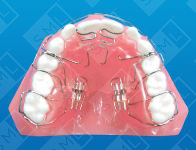 Sagittal with Recurved Springs