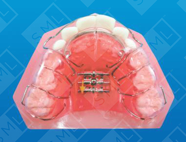 Schwarz with Posterior Bite Plane