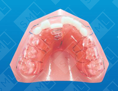 Single Tooth Anterior Crossbite with Bite Plane_0.jpg