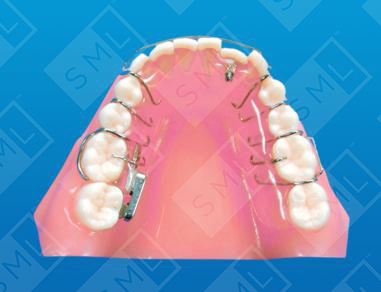 Single Tooth Molar Uprighter_0
