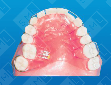 Single Tooth Posterior Crossbite