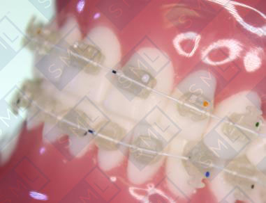 Tooth-Colored Arch Wires