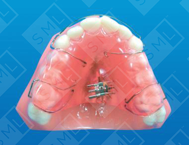 Unilateral Posterior Crossbite_0
