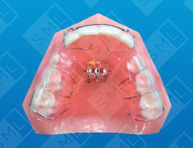 Upper Anterior Crossbite