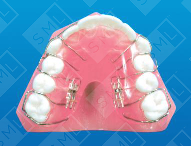 Upper Sagittal to Distalize Molars
