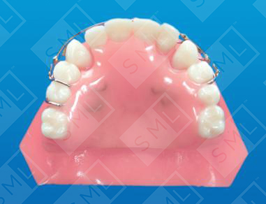 Upper Treatment Partial to Gather Flared Anteriors