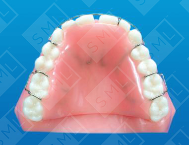 Upper Treatment Partial with Tooth Movement