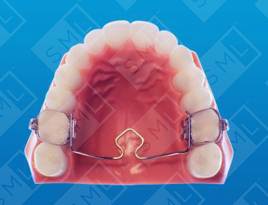 Wilson-Transpalatal-Arch_0